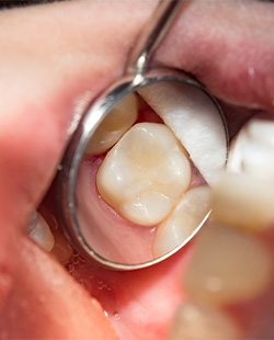 Closeup of tooth in dental mirror