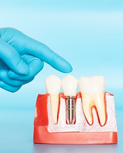 Blue-gloved finger pointing to model dental implant