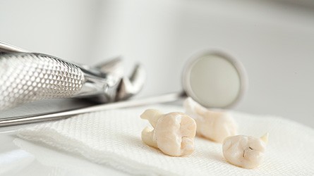 Three extracted teeth on a piece of gauze next to dental instruments